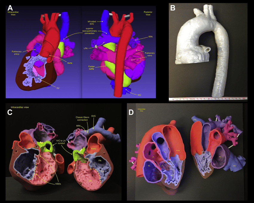 Adult Congenital Heart Disease: Common Lesions, Symptoms, and When to Intervene