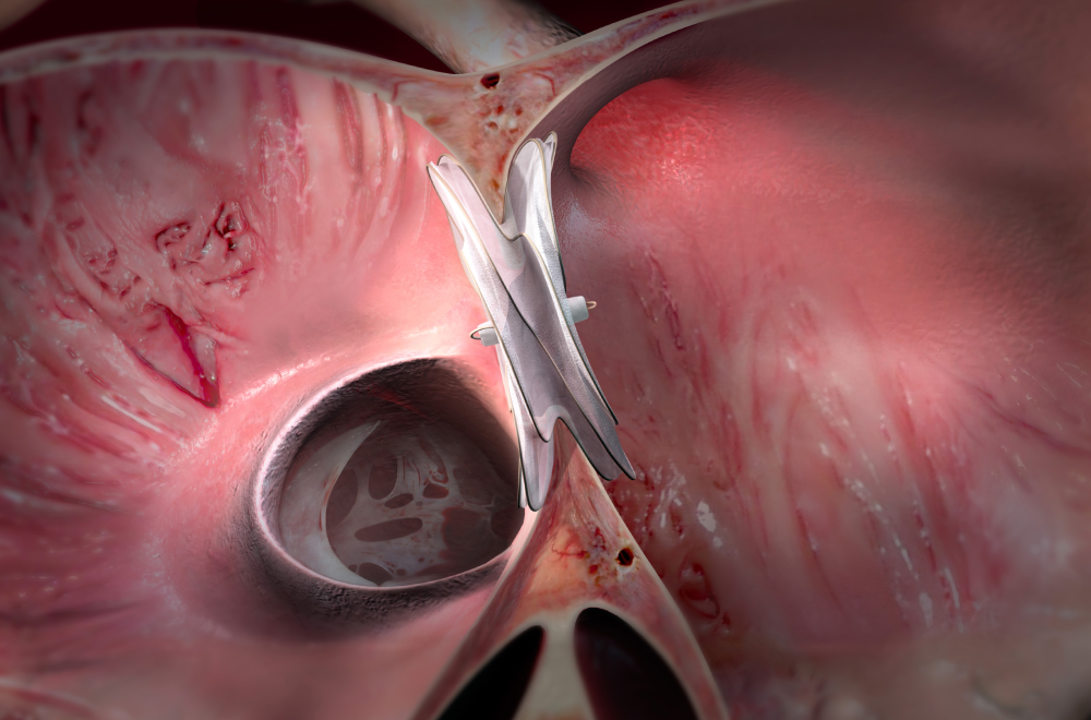 ASD Device Closure Procedure