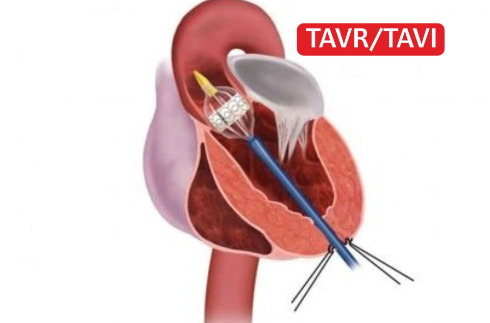 TAVI/TAVR